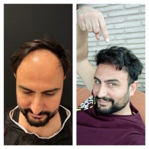 Vorher-Nachher Haartransplantation Antalya Vorher-Nachher Haartransplantation Antalya