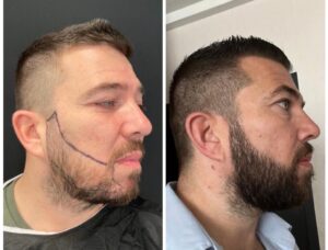 Vorher-Nachher Barttransplantation Antalya