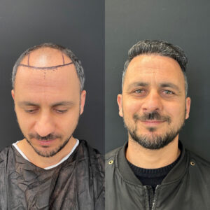 Vorher-Nachher Haartransplantation Türkei Vorher-Nachher Haartransplantation Türkei